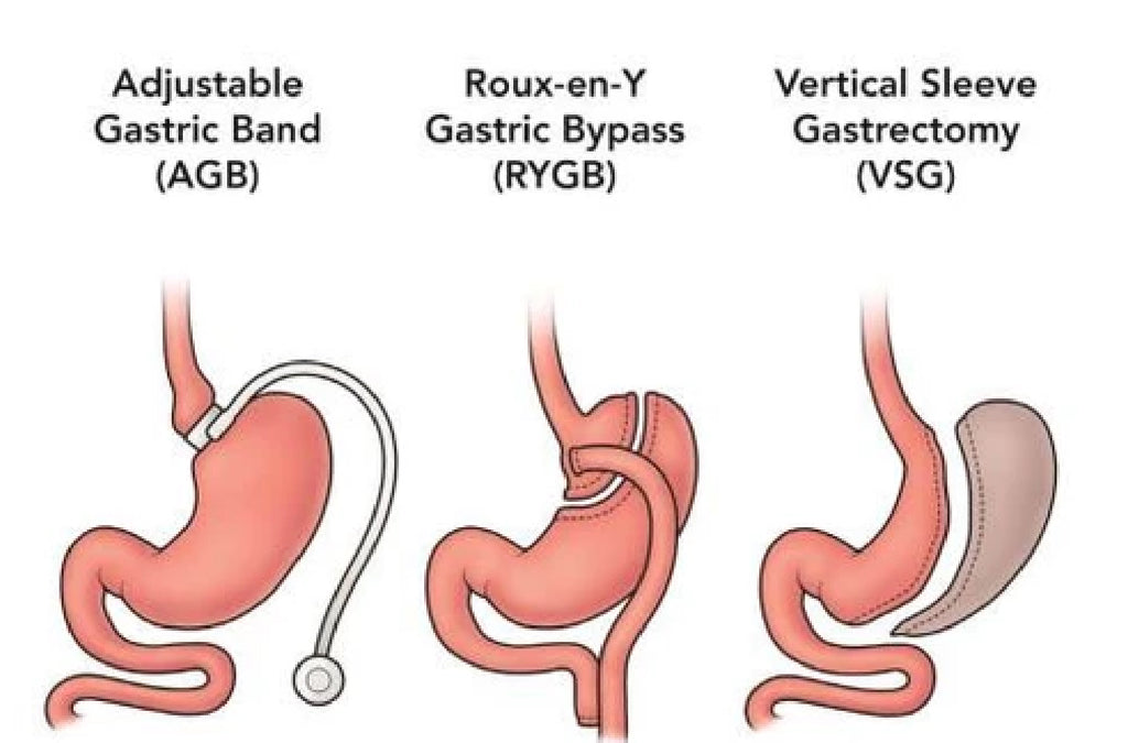 Types of Weight Loss Surgery
